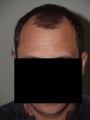 Hair Transplant