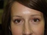Eyebrow Transplant