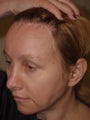 Hairline Transplant