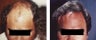 hair transplant