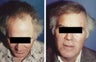 hair transplant