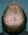 Hair transplant