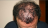 Hair Transplant