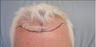 Hair Transplant