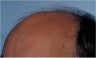 Hair Transplant