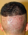 Neograft hair transplant donor site