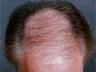 Hair Transplant