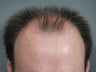 Hair Transplant