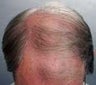 Hair Transplant