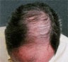 Hair Transplant