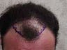 Hair Transplant
