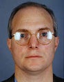 Hair Transplant