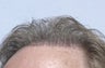 Hair Transplant