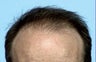 Hair Transplant