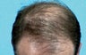 Hair Transplant