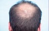 Hair Transplant