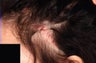 Hair Transplant