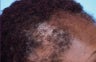 Hair Transplant