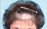 Hair Transplant