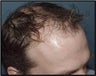 Hair Restoration