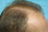 NeoGraft hair transplant