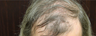 NeoGraft hair transplant