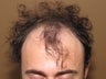 FUE hair transplantation