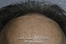AccuGraft Hair Transplant
