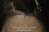 AccuGraft Hair Transplant