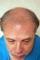 Hair Transplantation