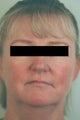 Rosacea and Facial Spider Veins