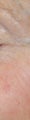 Spider hemangioma (blood freckle) laser treatments