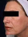 IPL treatments