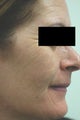 Photofacial