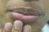 Brown Spots on the Lips