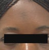 Scar Removal for Black Skin