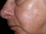 Intense Pulsed Light