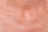 Chest skin rejuvenation using pulsed light