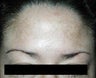 IPL (Intense Pulsed Light)