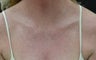 Intense Pulsed Light