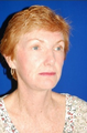 Facelift, Intense Pulsed Light