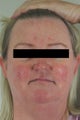 Rosacea and Facial Spider Veins