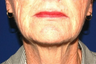 Facelift, Intense Pulsed Light