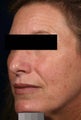 IPL treatments