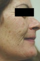 Photofacial