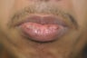Brown Spots on the Lips