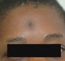 Scar Removal for Black Skin