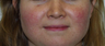 IPL Treatments