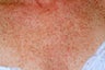 Chest skin rejuvenation using pulsed light