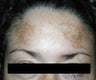 IPL (Intense Pulsed Light)